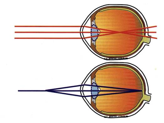 近视眼（上）和正常眼（下）